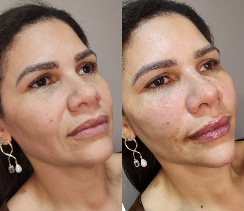 Resultado de harmonização facial — caso 2