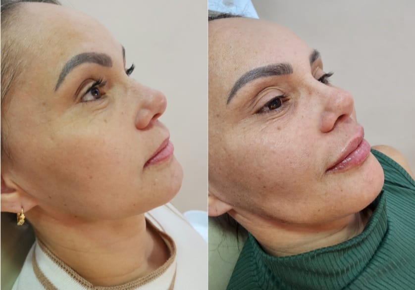 Resultado de harmonização facial — caso 5