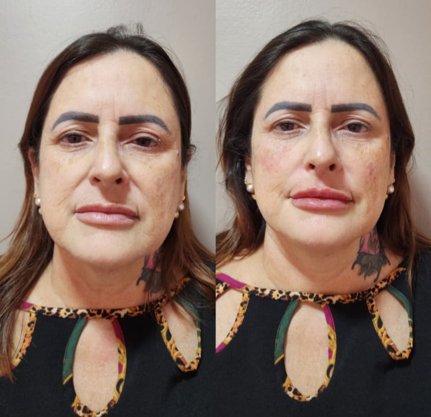 Resultado de harmonização facial — caso 3