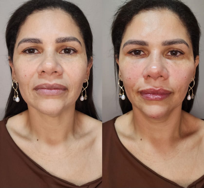 Resultado de harmonização facial — caso 1