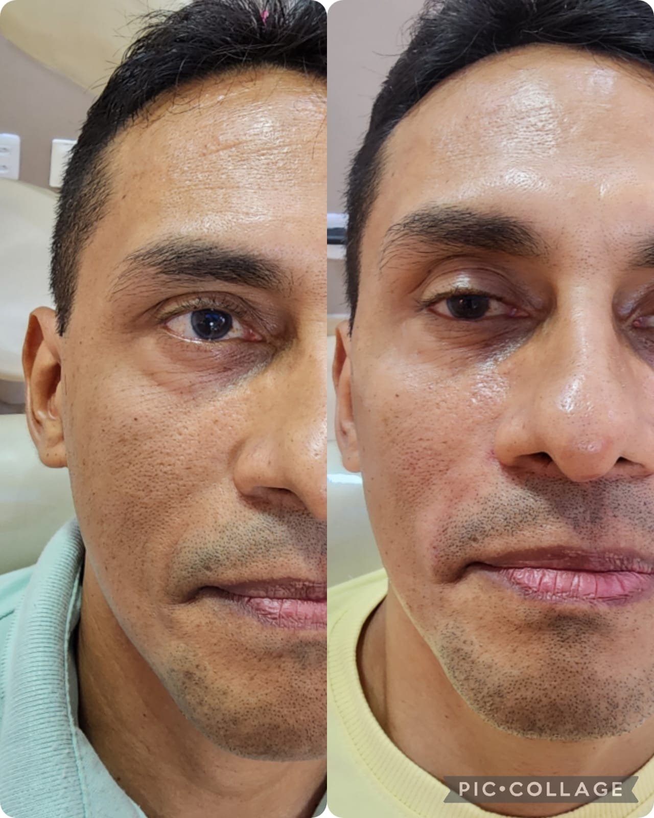 Resultado de harmonização facial — caso 4