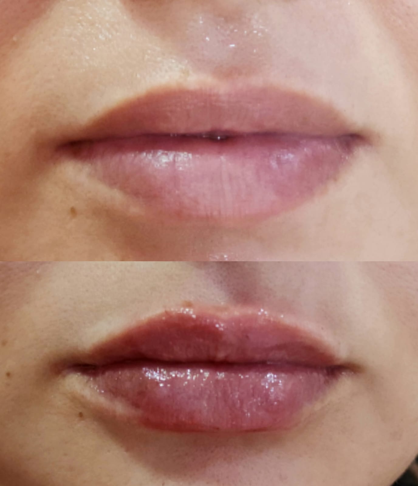 Resultado de harmonização facial — caso 6